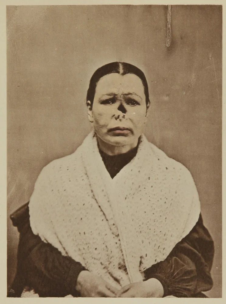 sad facial expression photo — Noseless woman